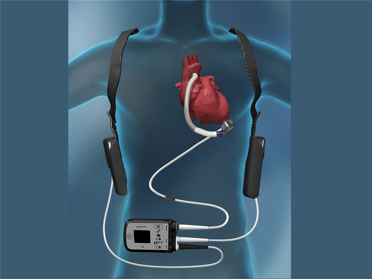 Bodovano predavanje „Kardiološka rehabilitacija pacijenta nakon ugradnje LVAD-a – prikaz...