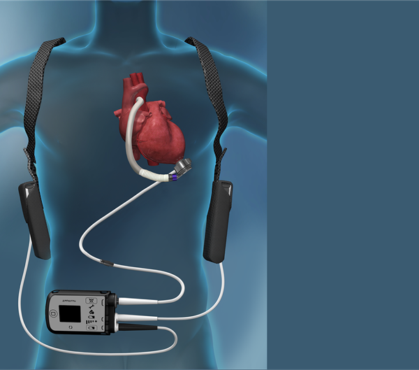 Bodovano predavanje „Kardiološka rehabilitacija pacijenta nakon ugradnje LVAD-a – prikaz slučaja”