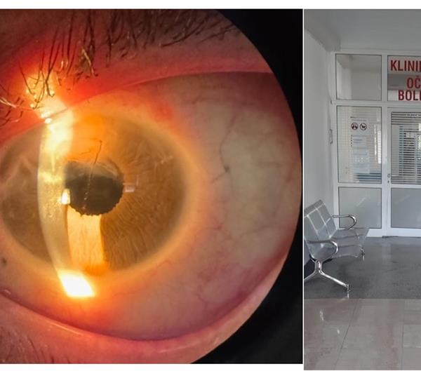 Prva ugradnja umjetne šarenice tipa ARTIFICIALIRIS u Hrvatskoj – novi standard u funkcionalnoj i estetskoj obnovi oka