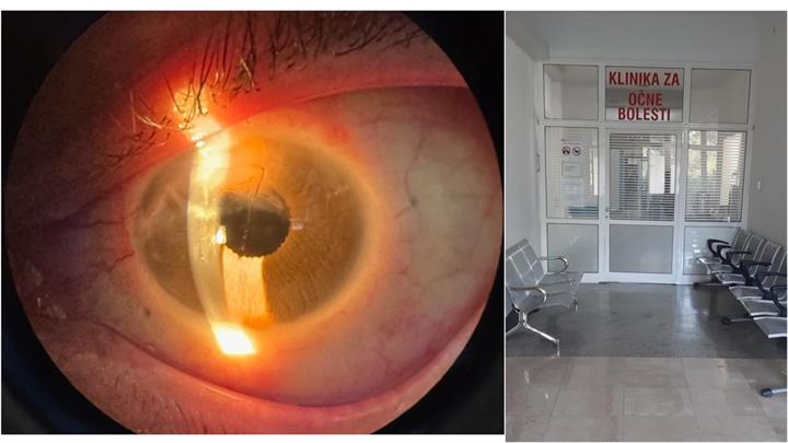 Prva ugradnja umjetne šarenice tipa ARTIFICIALIRIS u Hrvatskoj – novi standard u funkcionalnoj i estetskoj obnovi oka